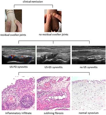 Clinical, Imaging, and Pathological Suppression of Synovitis in Rheumatoid Arthritis: Is the Disease Curable?